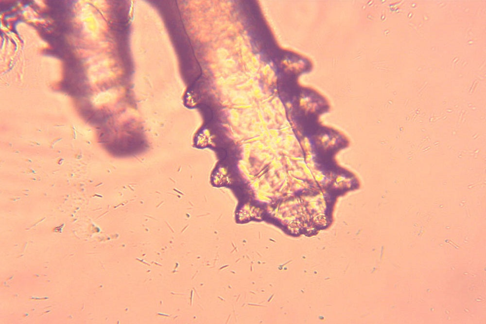 Blepharitis and Dry Eye: The Chicken or the Egg?