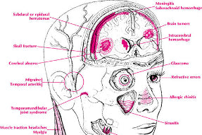 Headaches, eye-aches and vision changes